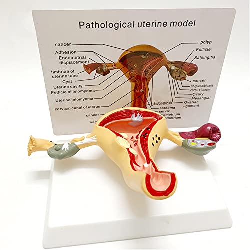 Uterus & Eierstock Pathologisches Modell Human Uterus Modell, krankes Uterus-Modell for Ärzte Büro Pädagogisches Werkzeug von ATJOGWIN