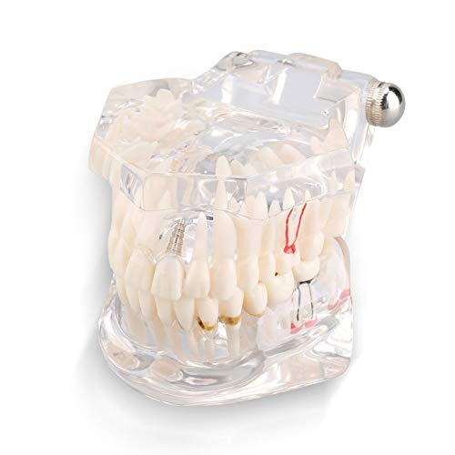 Zahnmodell , Akozon Dental Standard Lehrzahnmodell Kinder Prothesenmodell Abnehmbarer Zahn Pathologisches Lehrmodell Demonstration Tool von Akozon