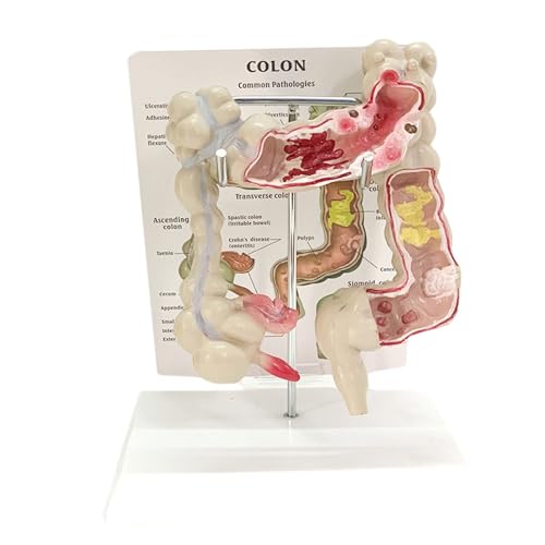 BALENFAY Dickdarmmodell der Humanpathologie mit PVC-Strukturen for kolorektale Erkrankungen, 18 x 14 x 25 cm von BALENFAY