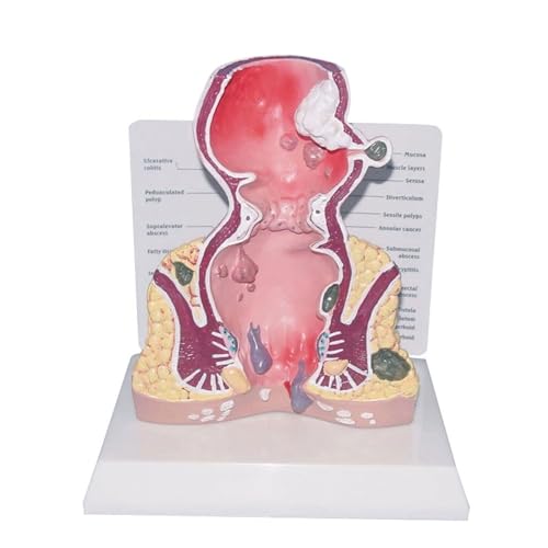 BALENFAY Menschliche Pathologien des Rektums Anatomisches Modell Hämorrhoiden Pathologische Erkrankungen Darm Medizinisches Lehr-Lernwerkzeug von BALENFAY