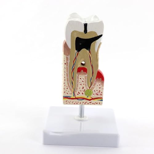 BALENFAY Vergrößertes menschliches Zahnpflegemodell, Karies, Zahnkaries, Medizinstudent, medizinische Versorgung, Lehrmittel, anatomisches Modell von BALENFAY