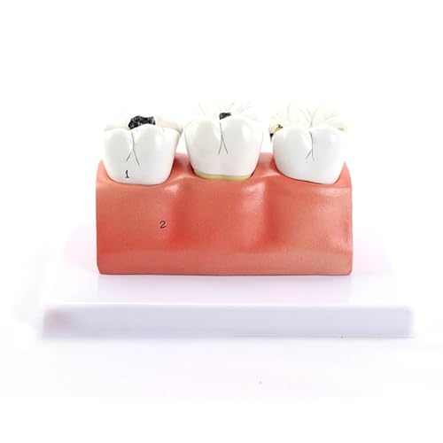 BALENFAY Vergrößerung Karies Zersetzung Anatomisches Modell Zahnmodell Orales Zahnpflegemodell for den medizinischen Unterricht von BALENFAY