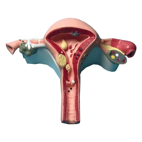 BALENFAY Weibliches Uterusmodell, Lehrmodelle Pathologisches Uterus-Anatomiemodell, menschliche Organanatomie, medizinische Anatomie menschliches Uterusmodell for Ärzte von BALENFAY