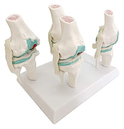 Anatomiemodell für den naturwissenschaftlichen Unt Kniegelenk Modell vier Stufen der pathologischen Gelenke menschliche medizinische Anatomie flexible Knieskelett-Unterrichtsform (Größe: 28x17x16cm) von BROHN