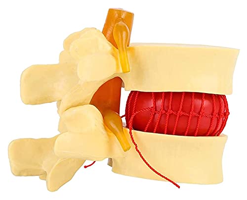 Anatomiemodell für den naturwissenschaftlichen Unterricht – Anatomische menschliche Wirbelsäule Lendenwirbelsäule Degenerative Lendenwirbel-Disc-Herniations-Demonstrationsmodell von BROHN