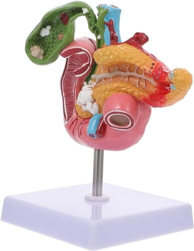 Gallensteinchirurgie Gastroenterologiesystem Hepatobiliäres Modell Pathologisches Modell Der Gallenblase Biologie-Lehrmodell Pankreasmedizin Pankreas Zwölffingerdarm Gallenblase Pathologisches von FYYYSLKX