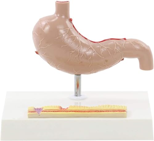 Magenperforation, Magenanatomie, Pathologisches Modell, Gastroenterologie, Menschliches Magenanatomiemodell, Menschliches Magenläsionsmodell, Anatomisches Pathologisches Pathologisches Magenmodell von FYYYSLKX