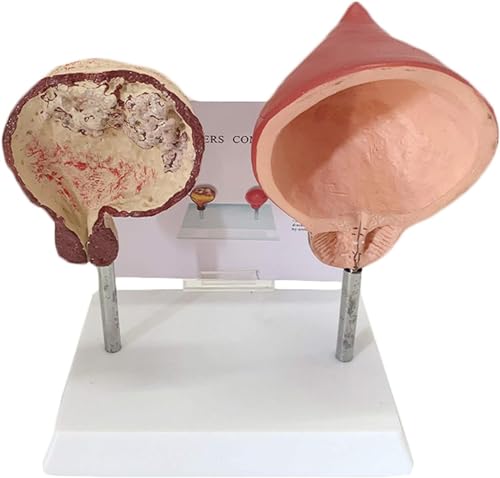 Modell Des Menschlichen Harnsystems - Blasenmodell - Vergleichsmodell Der Raucherblase Und Der Normalen Blase Vergleich Der Menschlichen Blase Vergleichsmodell Der Gesunden Menschlichen von FYYYSLKX