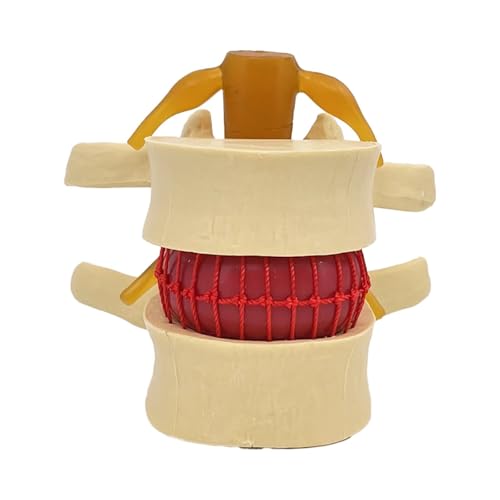 Anatomisches Modell zur Demonstration eines Bandscheibenvorfalls im menschlichen Lendenwirbelbereich zum Lehren und Lernen des Lendenwirbelsäulenmodells von GTRpenico