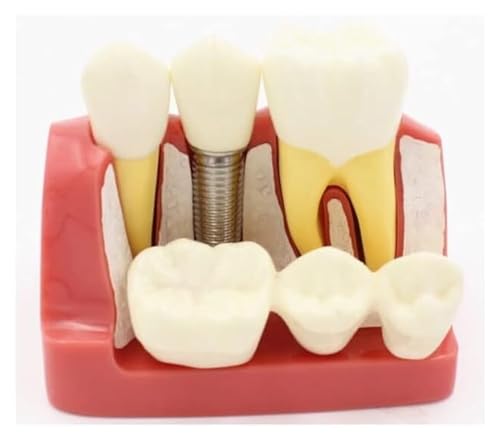 Anatomischen 4-faches Pflanzenlösungsmodell, abnehmbares Analyse-Kronen-Brücken-Zahnmodell – for den Unterricht und das Studium von Organen Modell von HELGN