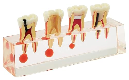 Anatomischen Demonstration eines kieferorthopädischen Modells, Lehrmodell for den Prozess der Wiederherstellung von Milchzahnkaries und Pulpa am Patienten Modell von HELGN