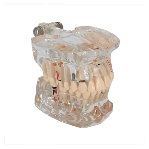 1Pc Transparent Dental Modell Zähne Restaurierung Brücke Zahn Implantat Modell for Studium Bildung Medizinische Wissenschaft Detal Produkte von Huhpa