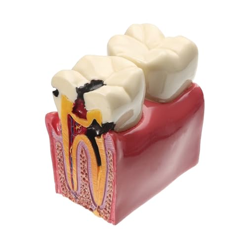 1pc 6-fache Vergrößerung von Zahnkaries Oralmodell medizinische Lehrmittel von Huhpa