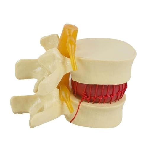 1pc Anatomische Wirbelsäule Bandscheibenvorfall Anatomie Menschliches Skelett Modell Medizinische Wissenschaft Lehre Lernen Liefert Werkzeug von Huhpa