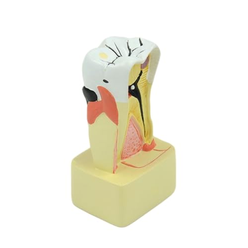 1pc Dental Pathologie Zähne Modell Parodontalen Modell for Zahnarzt Lehre Student Studie Medizinische Wissenschaft von Huhpa