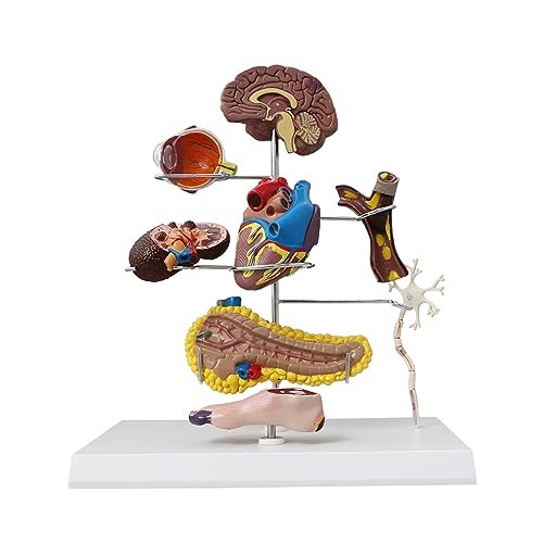 1pc Diabetes Modell Lehre Anatomische Pathologie Modell Auswirkungen Von Diabetes Details Pankreas Anatomie von Huhpa