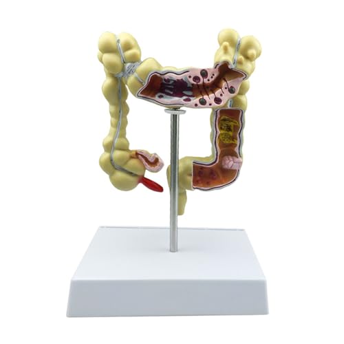 1set Kolorektale Läsion Modell Menschlichen Dickdarm Schlange Dickdarm Pathologische Krankheiten Modell Medizinische Organizer Anatomie von Huhpa