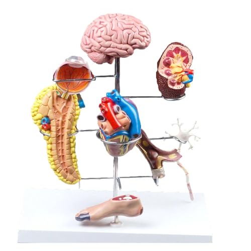 1set Menschliches Diabetes Modell Komplikationen Zerebrale Herz Pankreas Neuronale Fuß Lehrmittel Bildung von Huhpa