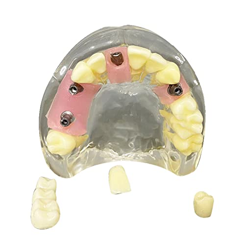 Erwachsene Implantat Zähne Anzeige Modell - Studium Modell Maxillary Dental Implantat Modell - Bildungsmodell Zähne Unterrichtsmodell Abnehmbare Reparatur - für Wissenschaft Demonstration Unterricht von LKYLVEE