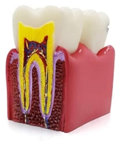 NICRX Anatomie Anatomiemodell, 6-faches Zahnkaries-Zahnmodell, Karies-Requisiten for den naturwissenschaftlichen Unterricht, Krankenhaus-Lehrorgane-Modell Modell von NICRX