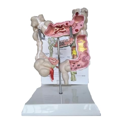 Anatomie Modell Anatomisches Modell Des Menschlichen Organs, Modell Der Kolorektalen Läsion, Medizinisches Anatomisches Modell Des Menschlichen Dickdarms, Dickdarm Anatomie Eines Falls von REIFOR