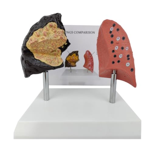 Anatomie Modell Menschliches Lungenmodell Vergleich Zwischen Raucherlunge Und Normaler Lunge Organmodell Modell Des Atmungssystems Anatomie Eines Falls von REIFOR