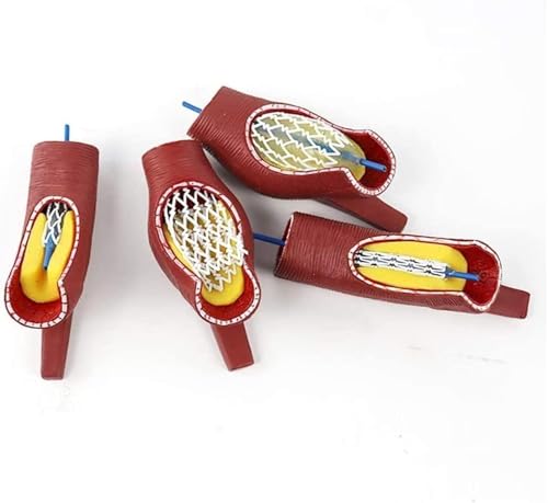 Anatomicals Gefäßstent-Modell, Demonstrationsmodell zur Vergrößerung menschlicher Blutgefäße, Gefäßblockade-Modell, Gefäßokklusionsmodell als schulmedizinisches Ausbildungshilfsmittel von RMJEZTQD