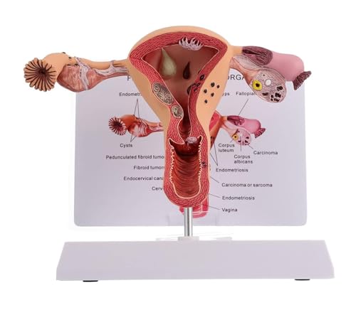 Anatomiemodell, pathologisches Gebärmutter-Eierstock-Modell des Menschen, anatomisches Modell der weiblichen Fortpflanzungsorgane, Gebärmuttermodell, medizinische Anatomie des Menschen als Lehr- und L von RMJEZTQD