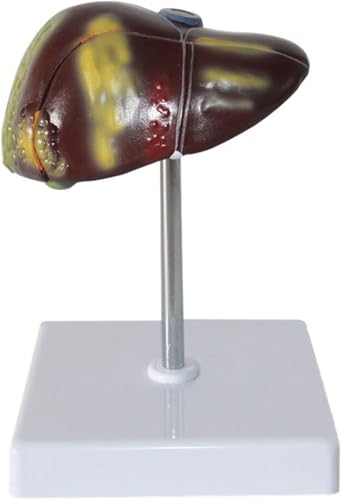 Anatomisches Modell der Gallenblase, Lehrmodell zur Pathologie der menschlichen Leber, anatomisches Modell einer Lebererkrankung in Lebensgröße, Modell einer Leber- und Gallenerkrankung mit Fettzirrho von RMJEZTQD