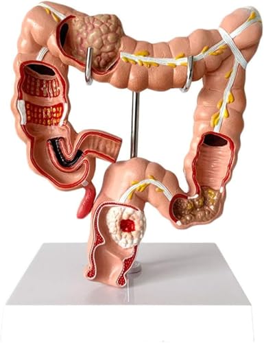 Anatomisches Modell des menschlichen Dickdarms, anatomisches Verdauungssystem, Modell viszeraler Läsionen – Modell der Dickdarmpathologie, Replik for die Ausbildung in menschlicher Anatomie und Physio von RMJEZTQD