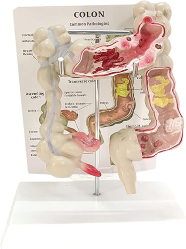 Modell des Verdauungssystems, Modell der menschlichen Pathologie des Dickdarms, Lehrmodell for die anorektale Gastroenterologie des Dickdarms und des Dickdarms, Pathologisches Lehrmodell for das Schul von RMJEZTQD