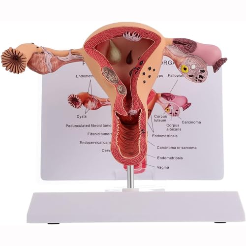 Weibliche Fortpflanzungsorgane Anatomie Modell Uterus Modell, Pathologischer Uterus und Eierstock Anatomisches Modell - Medizinische Anatomie der Frau von UNbit