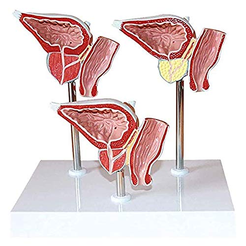 VDLLQYN, Anatomisches Modell des menschlichen Harnsystems, Modell einer Erkrankung der vorderen Fissurendrüse, dreiteilig, for Präsentationstool in der Schule ，Anatomie-Modelle von VDLLQYN