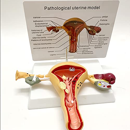 VDLLQYN, Medizinisches anatomisches menschliches Uterusmodell, anatomisches Uterus-Eierstock-Modell mit Pathologien, erweiterte Simulation der mütterlichen Uterusstruktur ，Anatomie-Modelle von VDLLQYN