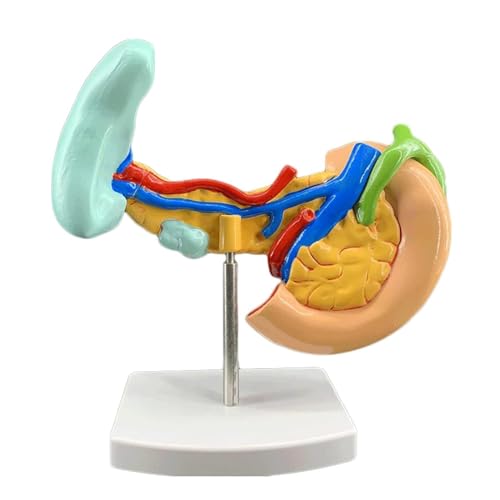Läsionsmodell For Das Bauchspeicheldrüsen-Anatomiemodell, Menschliches Organmodell, Läsion, Bauchspeicheldrüse, Milz, Leber, Gallenblase Und Zwölffingerdarmmodell, Lehrmodell von VERIMP