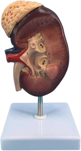 Nierenanatomie Mit Vergrößerung Der Nebenniere Modell Einer Erkrankten Niere 2-fache Vergrößerung Anatomischer Modus Der Menschlichen Niere Mit Genauer Anatomischer Struktur von VERIMP