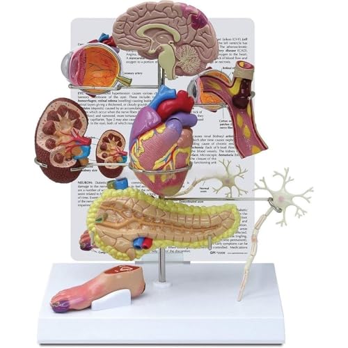 Human II -Diabetes -Anatomie -Modell 9 x 2 x 11 cm, Simulationsdiabetesmodell, multifunktionales Diabetes Modell 1PC von YJQHODY