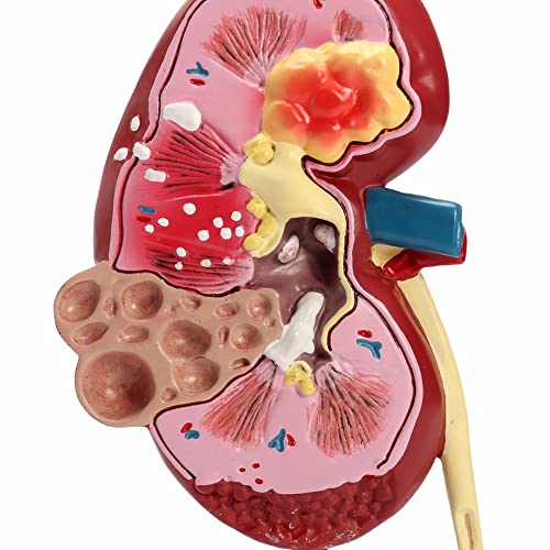 Anatomisches Modell der Niere, Modell der Nierenpathologien, Nachbildung der Anatomie des menschlichen Körpers einer erkrankten Niere als Lehrmittel von YXYFA