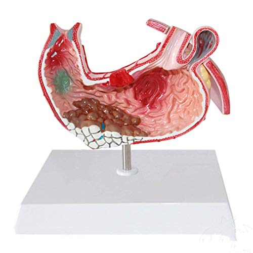 dsmsdre Bildungsmodell Menschliches Magenmodell Gastritis-Modell MagenläsionsmodellMit hochdetailliertem medizinischen Lehr-Lernwerkzeug Medizinische Modelle von dsmsdre